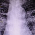 An X-ray image of an Appalachian coal miner with black lung lesions.