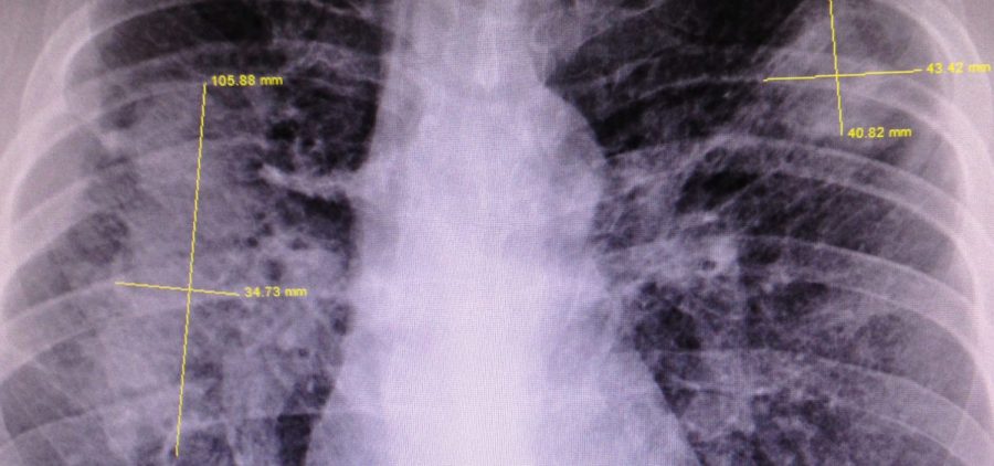 An X-ray image of an Appalachian coal miner with black lung lesions.