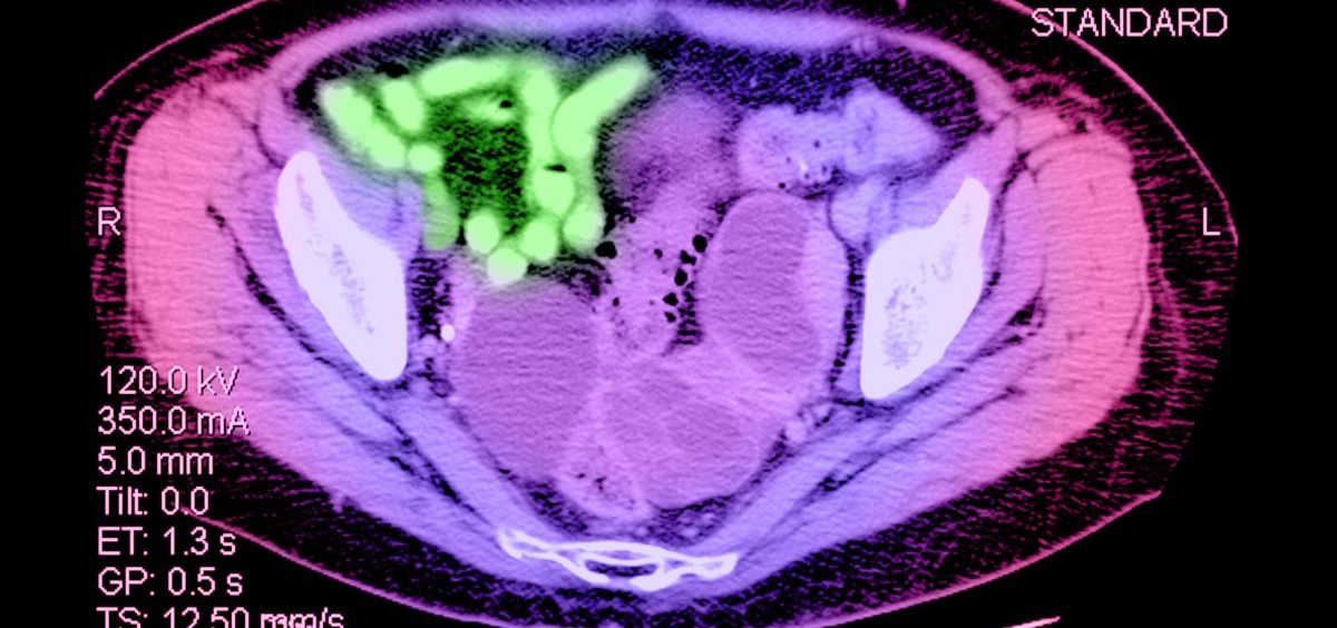 A CT scan depicting ovarian cancer.