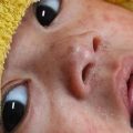 A baby with measles