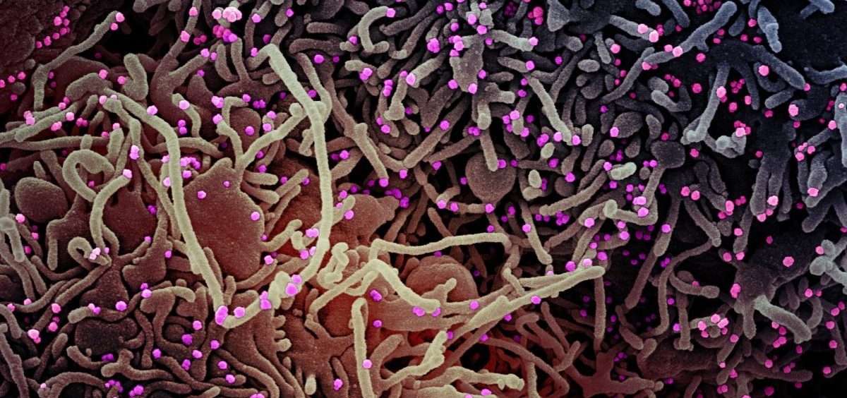 This image made by a scanning electron micrograph shows SARS-COV-2 virus particles (colorized pink) from a patient sample.