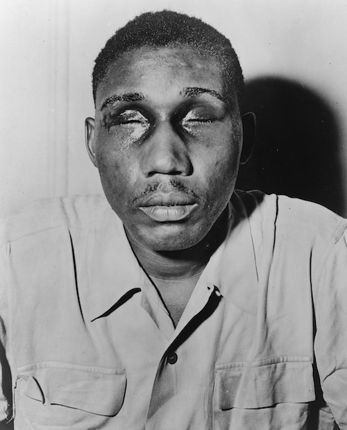 World War II veteran Isaac Woodard with eyes swollen shut from aggravated assault and blinding.
