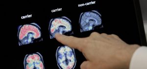 Dr. William Burke goes over a PET brain scan in 2018 at Banner Alzheimers Institute in Phoenix. The drug company Biogen Inc. has received federal approval for a medicine to treat early Alzheimer's disease.