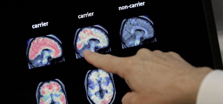 Dr. William Burke goes over a PET brain scan in 2018 at Banner Alzheimers Institute in Phoenix. The drug company Biogen Inc. has received federal approval for a medicine to treat early Alzheimer's disease.