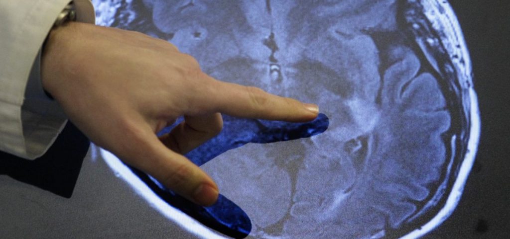 Dr. Paul Nyquist points to spots of possible damage caused by a stroke brain scan.