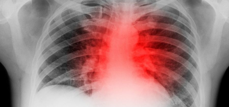 An Xray of a person's chest is highlighted red around the heart area
