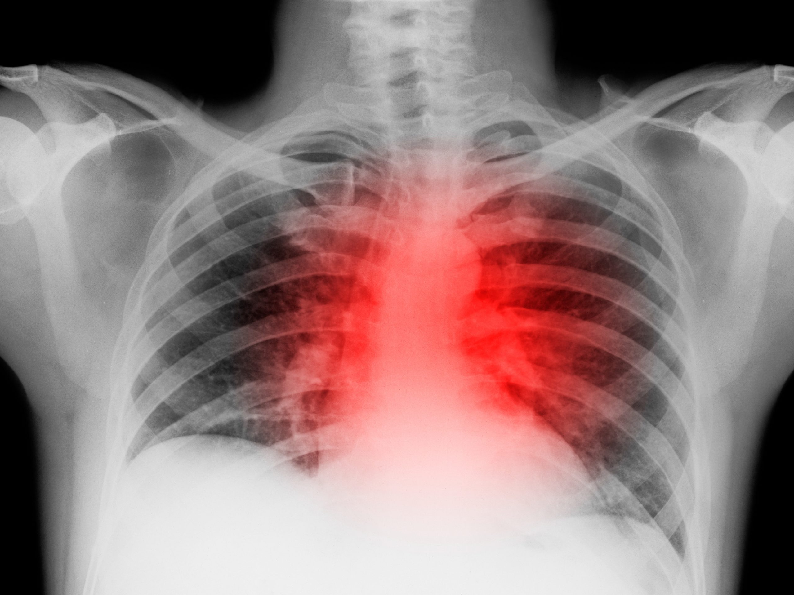 Разрыв легочной. Ушиб грудной клетки рентген. Рентген ребер грудной клетки. Сердце на рентгене грудной клетки.