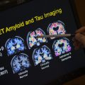 A doctor points to PET scan results that are part of Alzheimer's disease research.