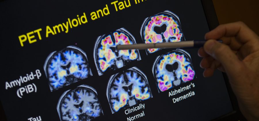 A doctor points to PET scan results that are part of Alzheimer's disease research.