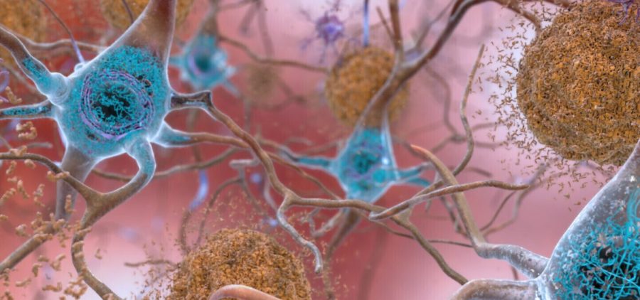 This illustration made available by the National Institute on Aging/National Institutes of Health depicts cells in an Alzheimer’s affected brain, with abnormal levels of the beta-amyloid protein clumping together to form plaques, brown, that collect between neurons and disrupt cell function. Abnormal collections of the tau protein accumulate and form tangles, blue, within neurons, harming synaptic communication between nerve cells. An experimental Alzheimer’s drug modestly slowed the brain disease’s inevitable worsening, researchers reported Tuesday, Nov. 29, 2022