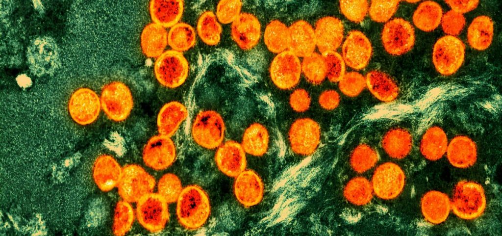 monkeypox virus particles (orange) are seen within an infected cell (green), after being cultured in a laboratory. The image was produced by a colorized transmission electron micrograph.