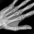 An X-Ray of a person's wrist and hand.