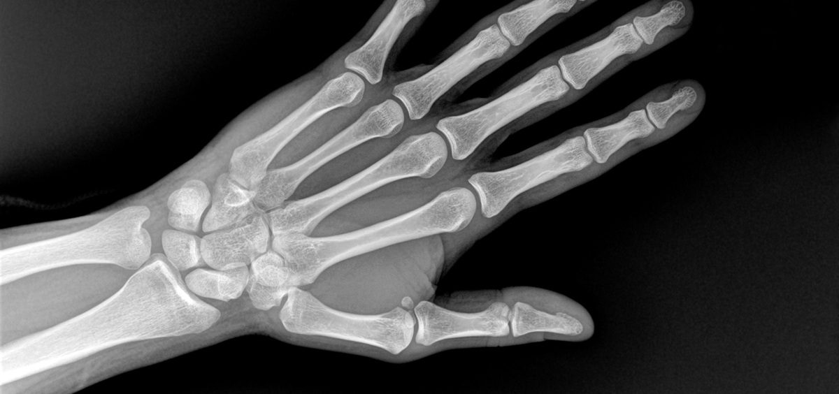 An X-Ray of a person's wrist and hand.